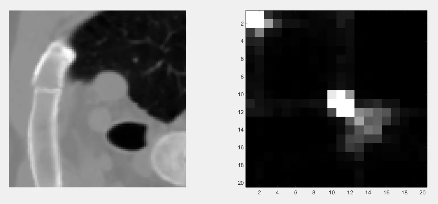 左图是原始的CT图像,右图是该图像的灰度共生矩阵