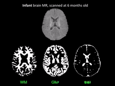 婴儿脑磁共振图像